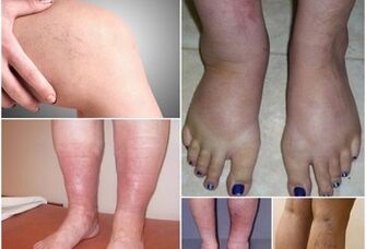 Photos of Varicose Varicose Demonstrations in the Legs