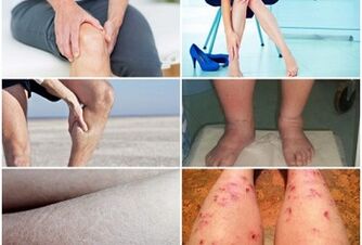 Symptoms of varicose veins in the legs
