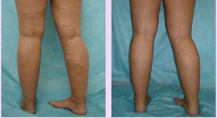 how the varicose veins of the first stage are manifested