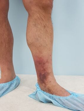 complications of varicose veins in men