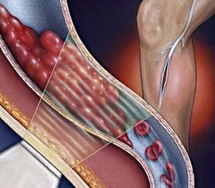 Deep vein thrombosis