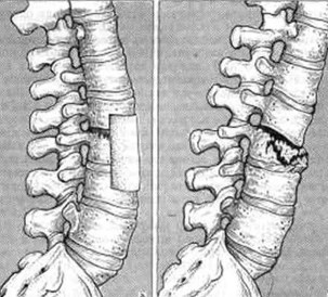 Injuries in the lumbar