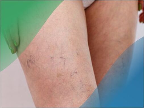 Vascular network in the legs is one of the symptoms of varicose veins