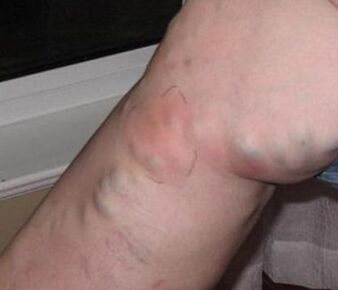 Thrombophlebitis in the leg with varicose veins