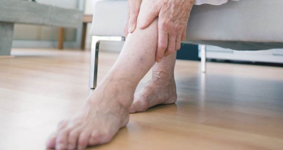 Varicose veins of the lower extremities caused by venous valve malfunction