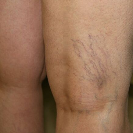 Venous meshwork in the lower extremities is a sign of varicose veins