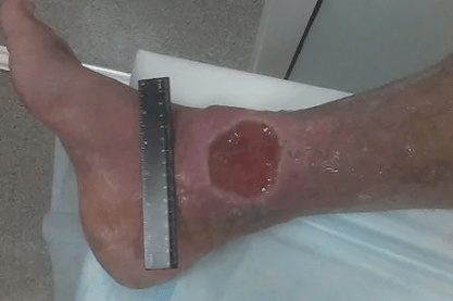 Varicose vein complications