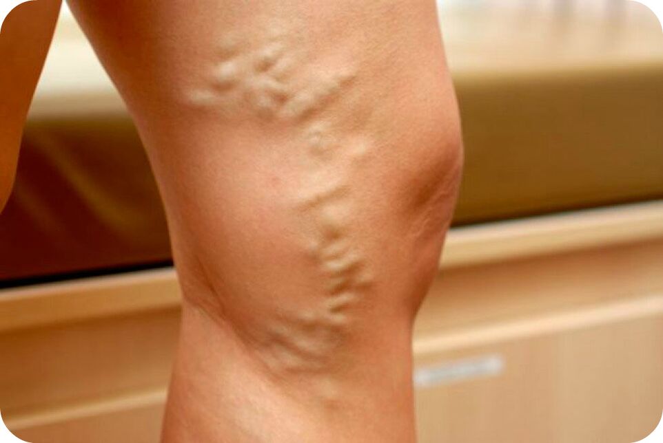 Veins veins varicose veins