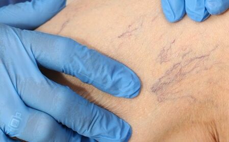 Varicose veins symptoms
