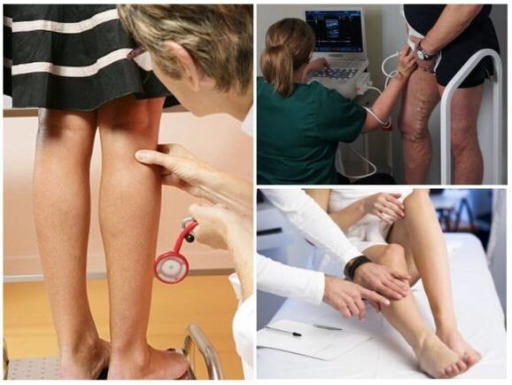 Varicose veins