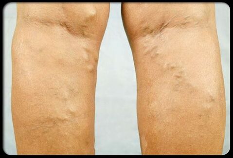Varicose veins in the legs